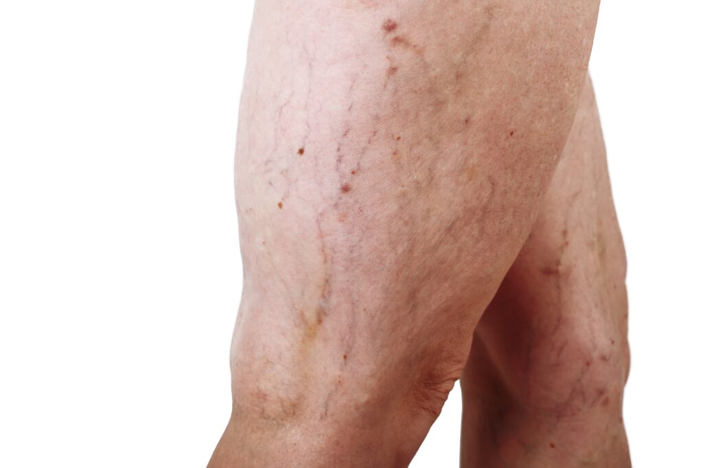 the disease varicose veins on a womans legs
