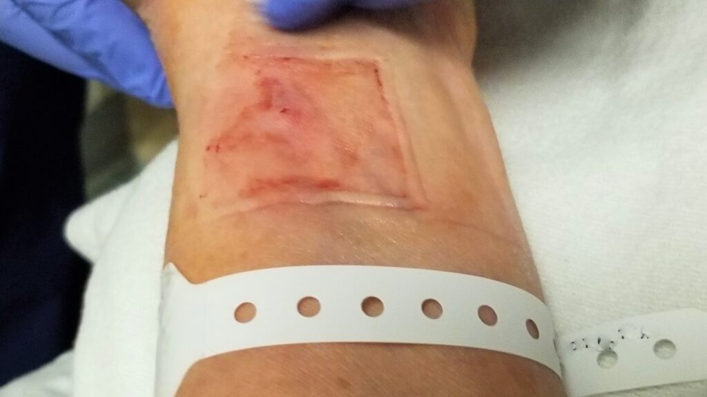 Wound Care! The Nurse Gently Cleans the Wound on the Patient's Wrist after Angioplasty.